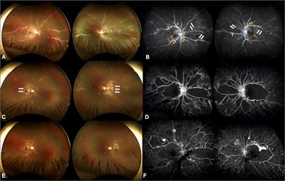 Hyperbaric oxygen therapy as rescue therapy for pediatric frosted branch angiitis with Purtscher-like retinopathy: A case report